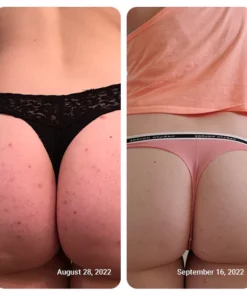 SOVASINE Butt & Thigh Acne Cream