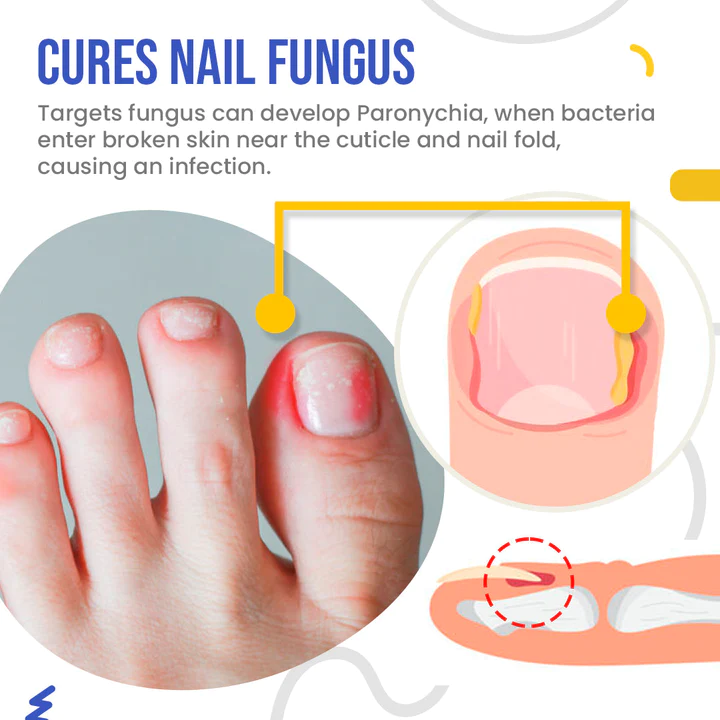 NailSpeed Light Cure Fungal Nail Pen