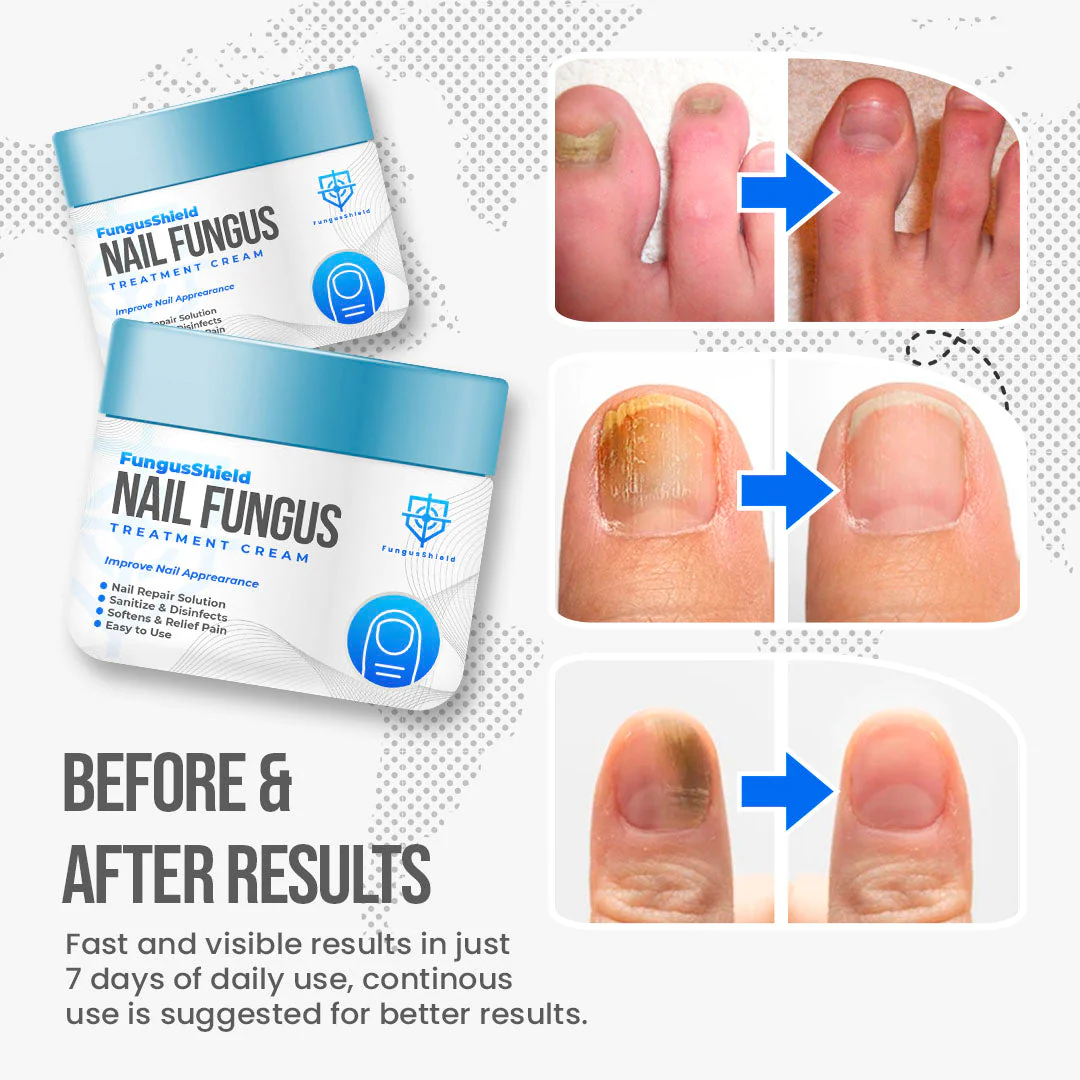 FungusShield Nail Fungus Treatment Cream