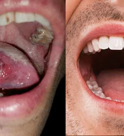 ARERAC Mouth Bleeding-Mouth Ulcers