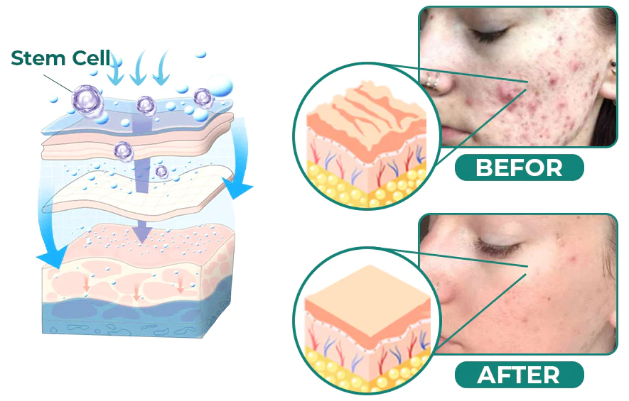 Furzero Advanced Medical-Grade Scar Gel With Stem Cells