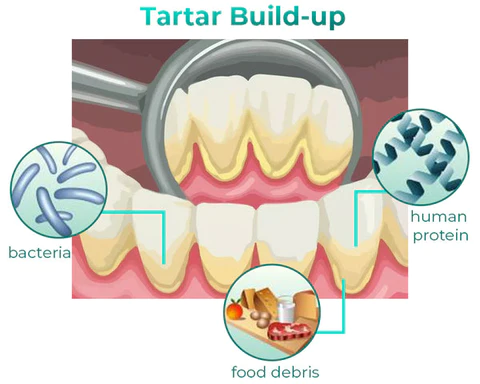 SmileMate Removal of Tartar and Plaque Bacteria and Various Oral Problems