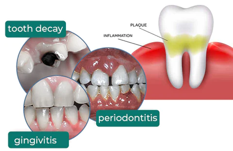 SmileMate Removal of Tartar and Plaque Bacteria and Various Oral Problems