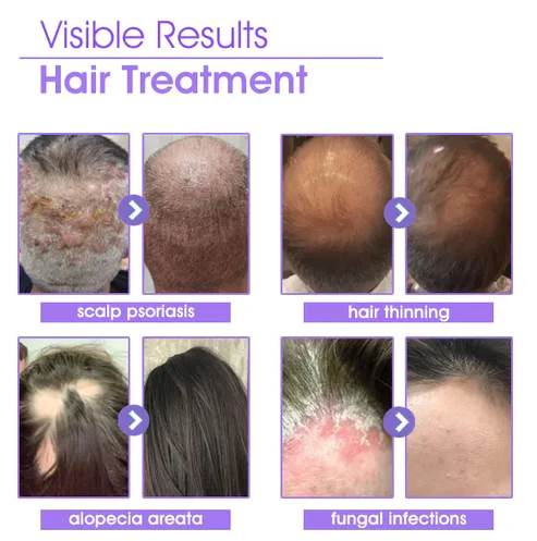 Fyndz Hair Follicle Repair Hair Growth Drops