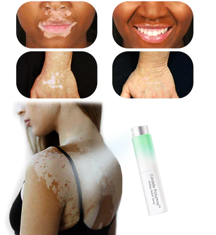 Canada Polumna Vitiligo Relief Spray