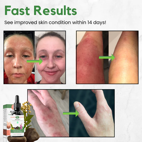 AEXZR Eczema Herbal Drops