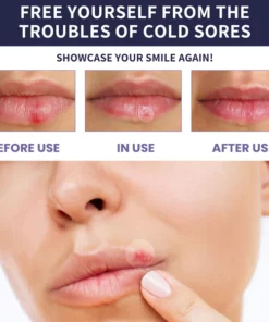 MediCure Healing Lip Patches