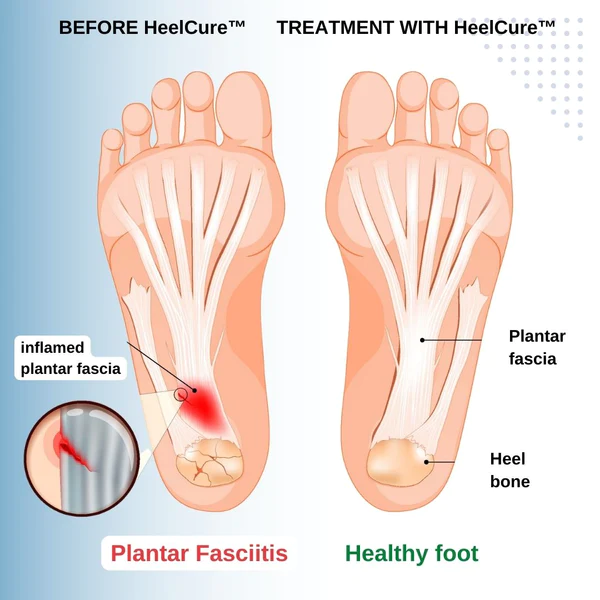 HeelCure Plantar Fasciitis Pain Relief Cream