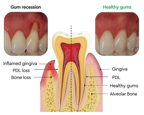 LIMETOW Gum Regrowth Drops