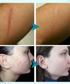 SkinFx Scar & Acne Bump Removal Cream