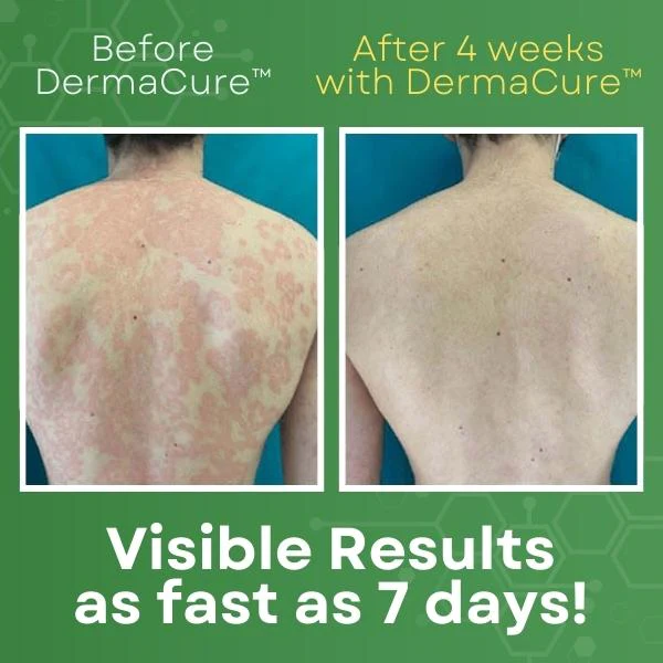 DermaCure Psoriasis Cream