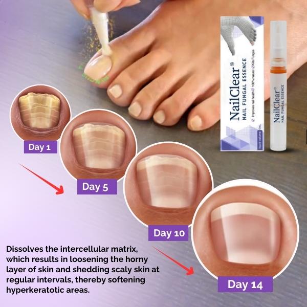 NailClear Nail Fungal Essence