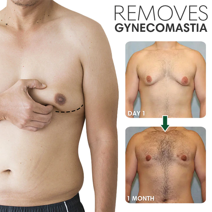 Gynecomastia Reduction Ointment