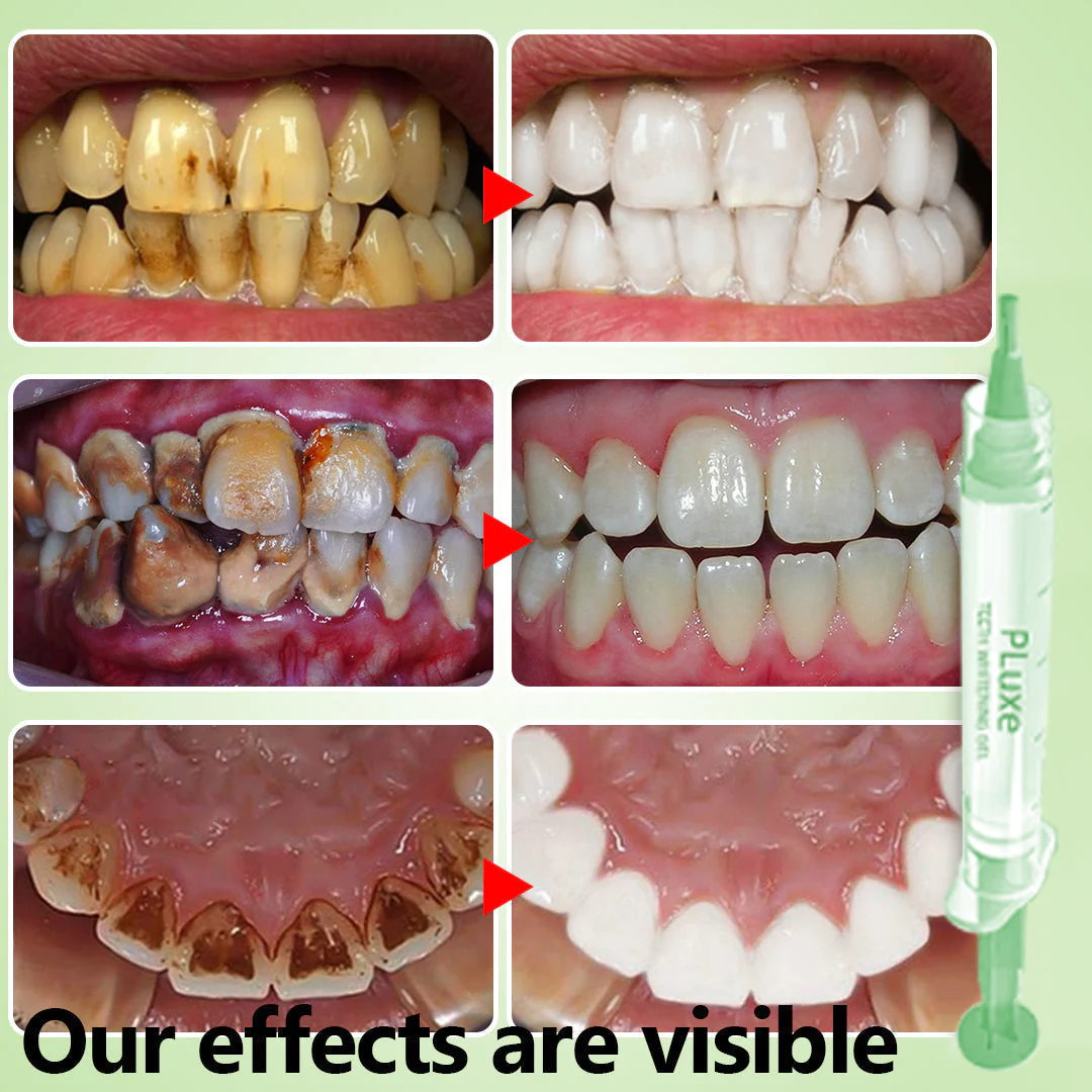 SharkŽ Teeth Whitening Gel