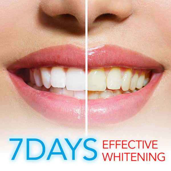 PureWhite Teeth Whitening Kit