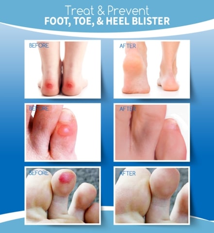 Hydrocolloid Healing Blister Plaster