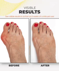 Feetin Bunion Relief Fit Patch