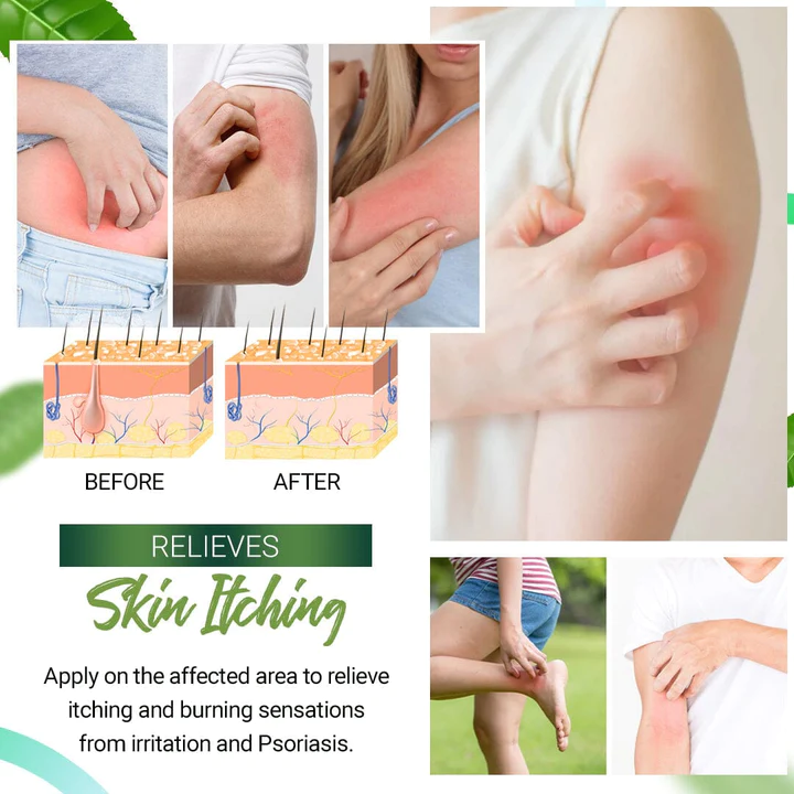 FunFree Psoriasis Soothing Ointment