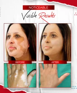 Vitiligo Relief Spray