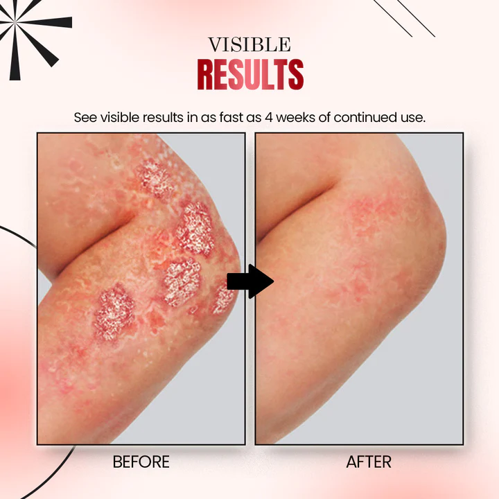 MEDix Psoriasis Therapy Spray