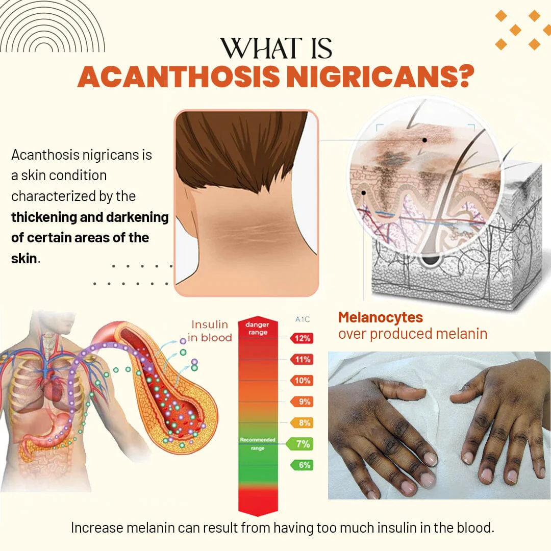 Zakdavi Acanthosis Nigricans Treatment Oil