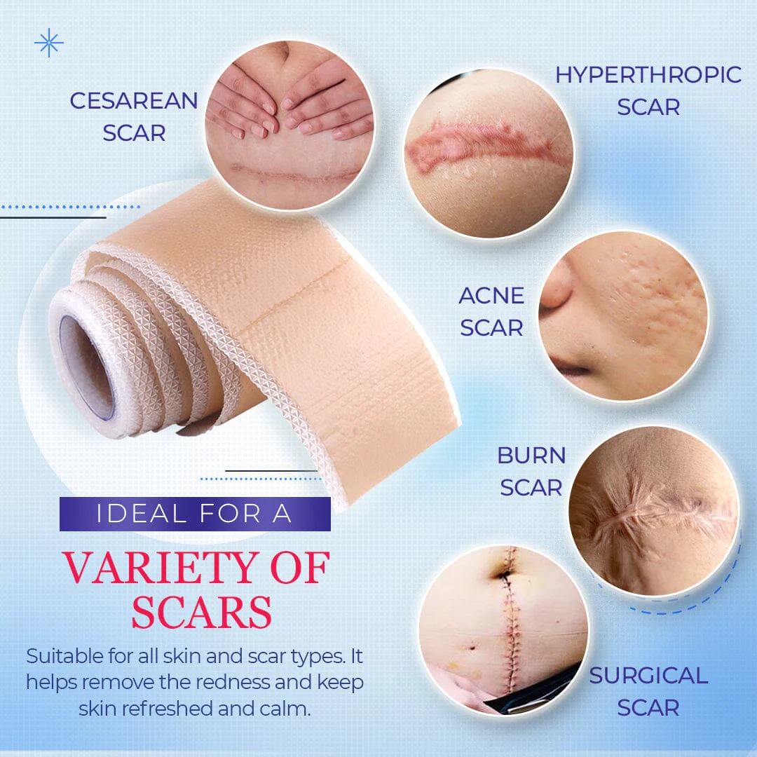 UltracareMedical Grade Silicone Scar Sheets