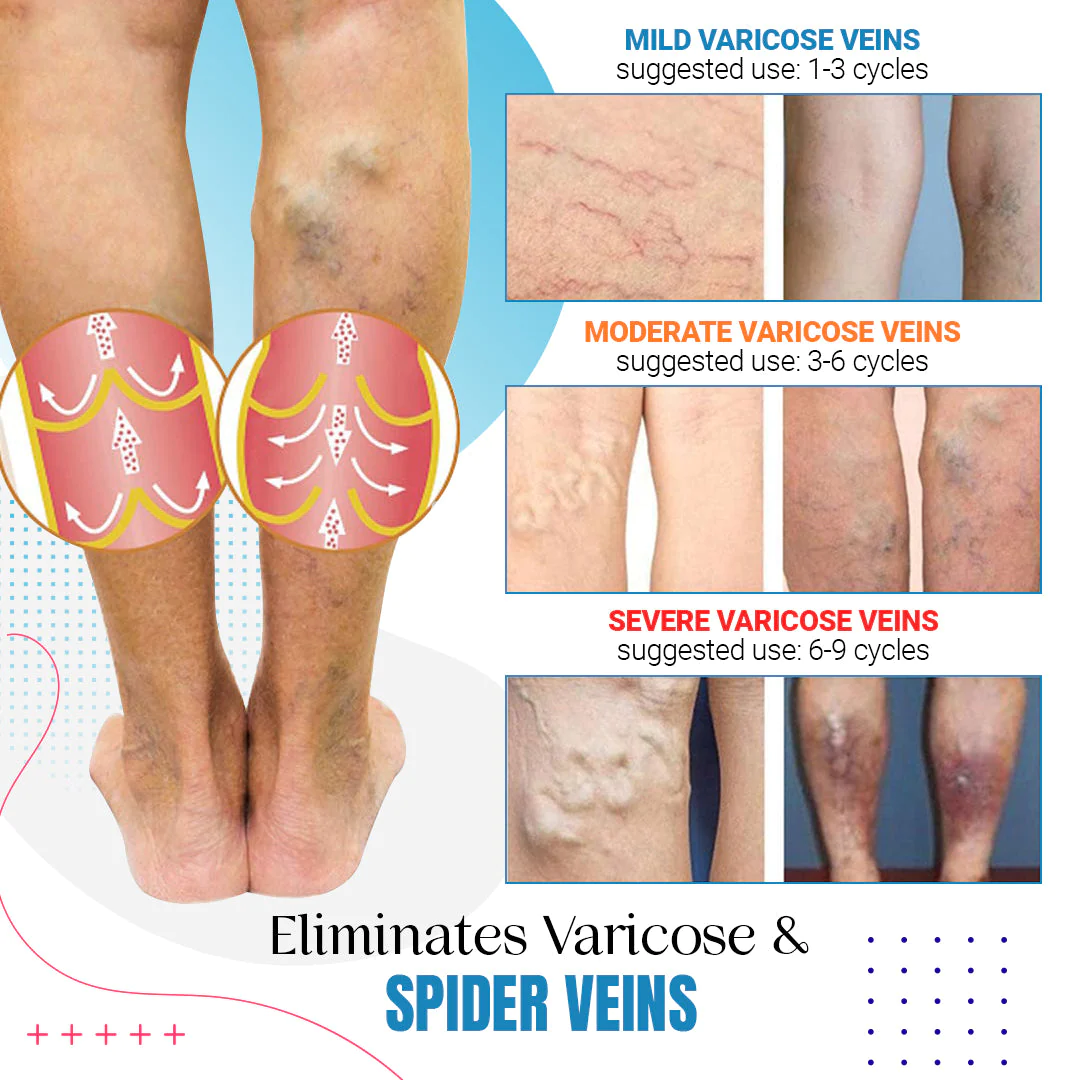 Raura Varicose Veins Treatment Spray