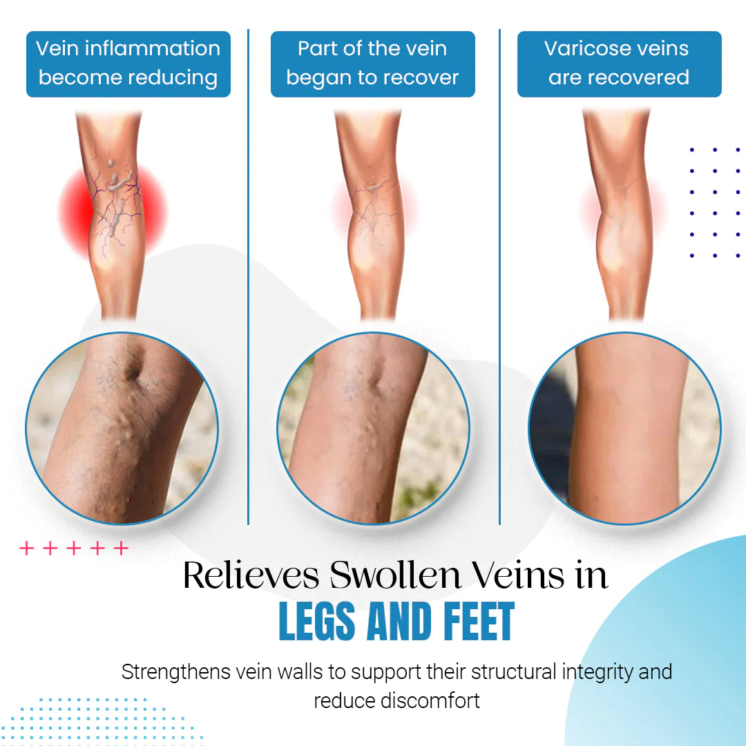 Raura Varicose Veins Treatment Spray