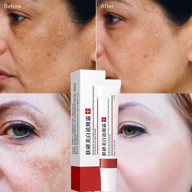 Freckle Whitening Cream