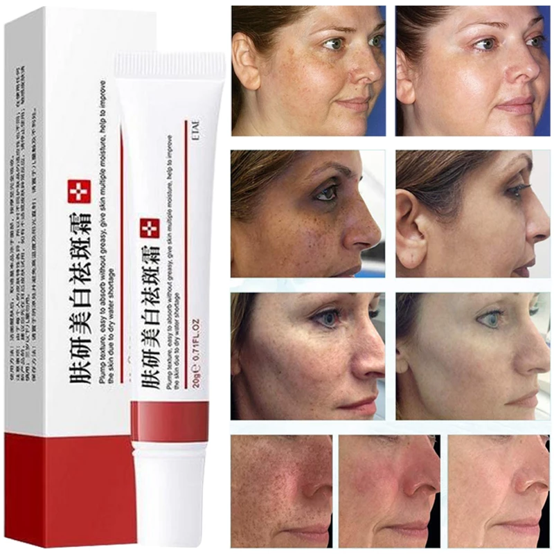 Freckle Whitening Cream