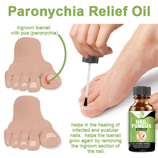 FOOTCURE Removal Paronychia Gel