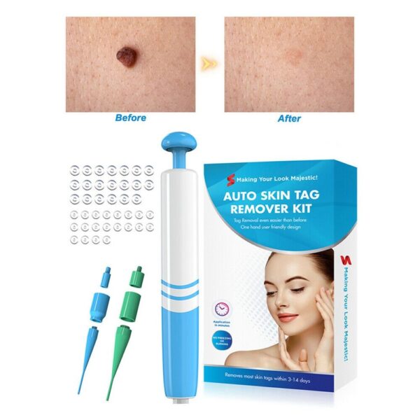 Auto Skin Tag Removal Kit