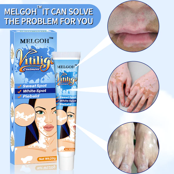 Melgoh Clinically Proven Vitiligo Ointment