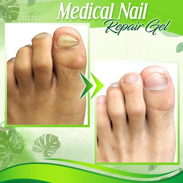 Toe Regeneration Beauty Gel