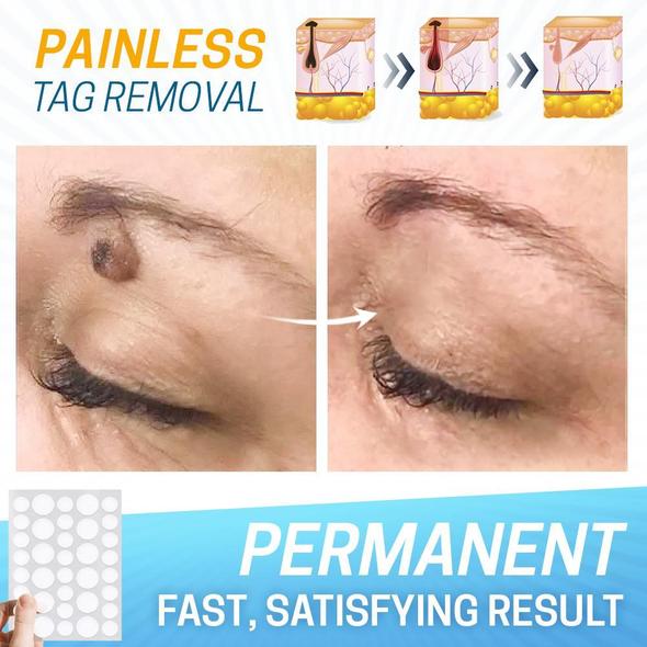 Skin Tag Pain-Free Remover Patch