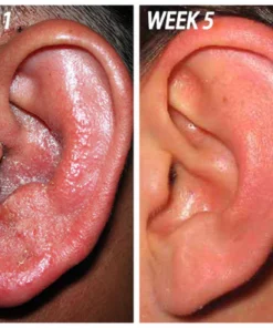 ClearEarŽ healing and restorative ear drop (cure for conditions such as external otitis, eczema, pseudomycosis of the ear canal, and tinnitus)