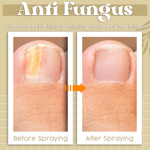 Anti-Fungal Foot Spray