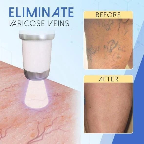 Blue Light Therapy Pen for Varicose Veins