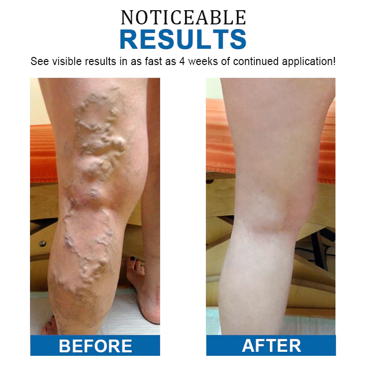 TrimVein Varicose Vein Care and Slimming Cream