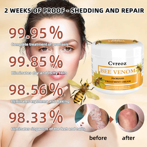 Cvreoz Bee Venom Psoriasis Treatment Cream