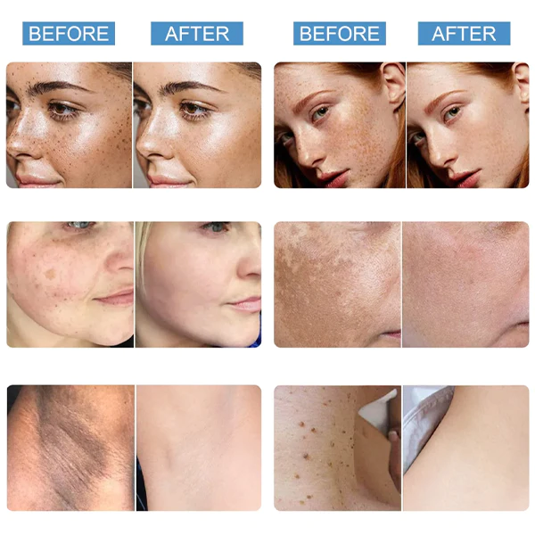 TLOPA Blemish Treatment serum for Dark Spots & Acanthosis Nigricans & Skin Tag