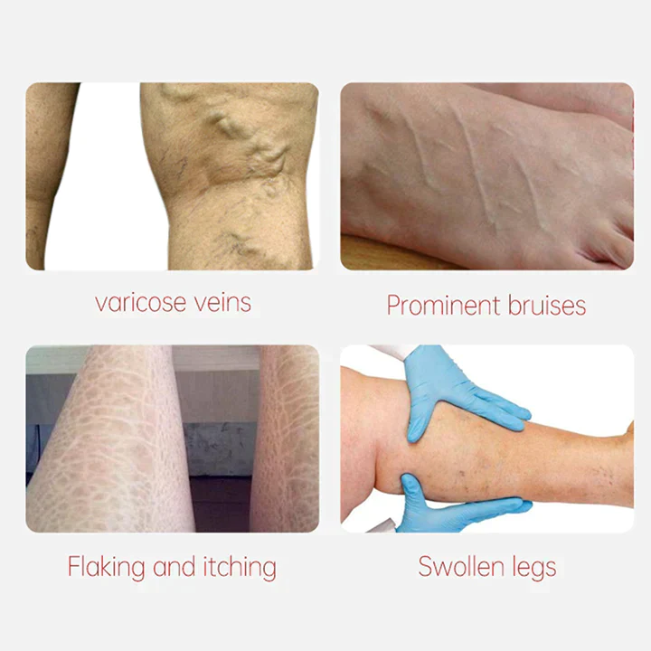 Oveallgo Varicose Veins Relief Cream