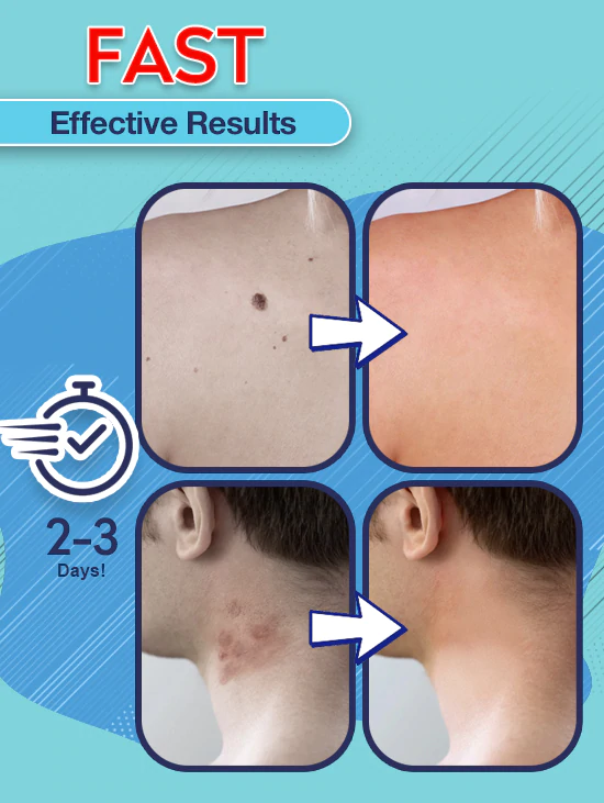 Instant Skin Tag Removal