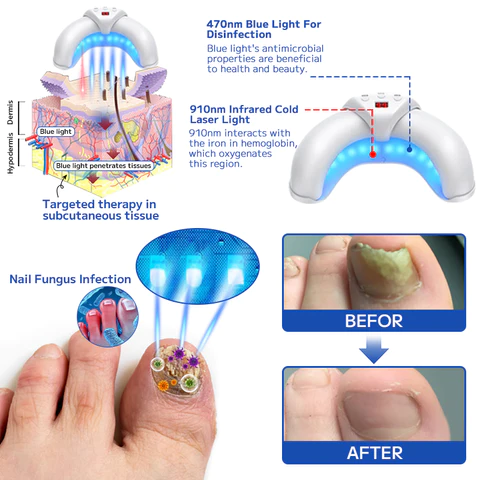 Furzero Fungal Nail Treatment Laser Device