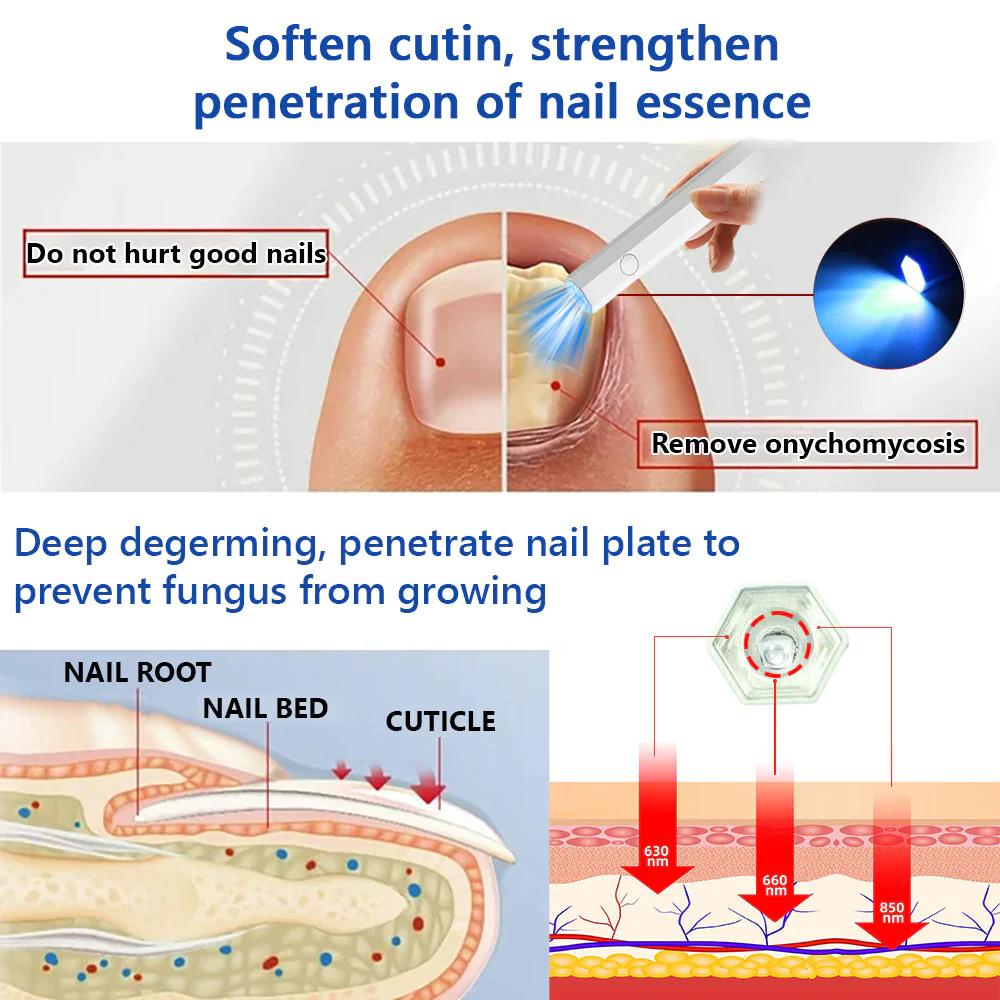 Furzero Toenail Fungus Laser Treatment Devices