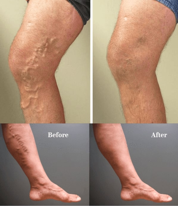 Varicose Veins Treatment Cream