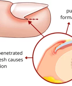 HealPatch Ingrown Toenail Corrector