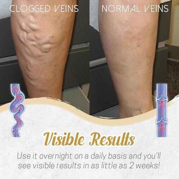 Herbal Detox Patch for Varicose Veins