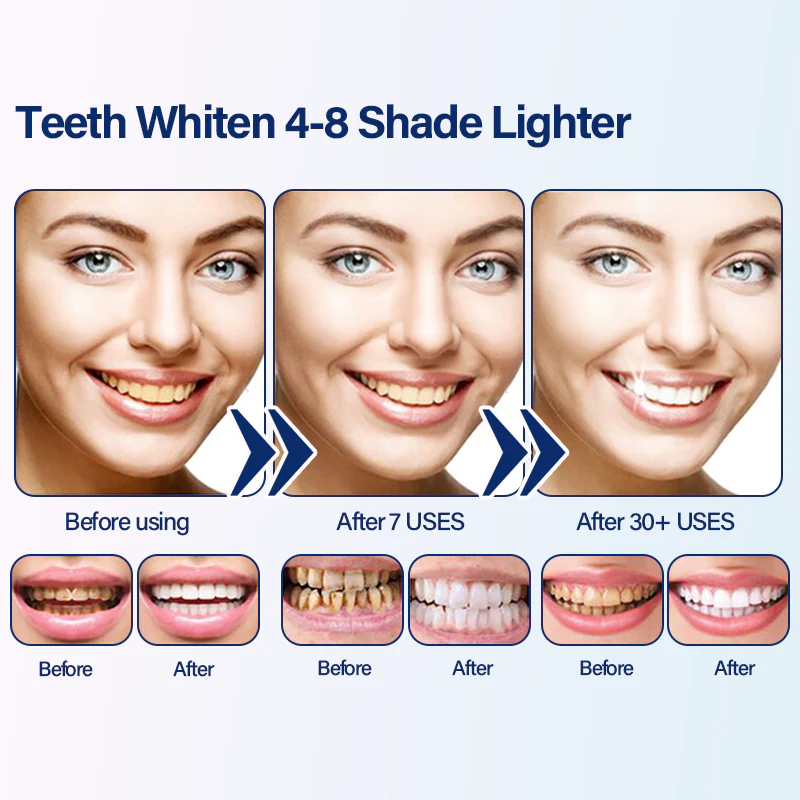 Oveallgo Medical-Grade Teeth Whitening Serum Pen