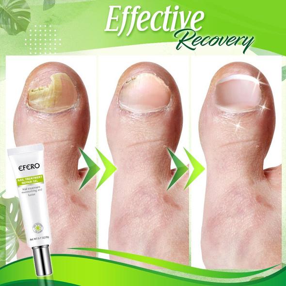 Toe Regeneration Beauty Gel